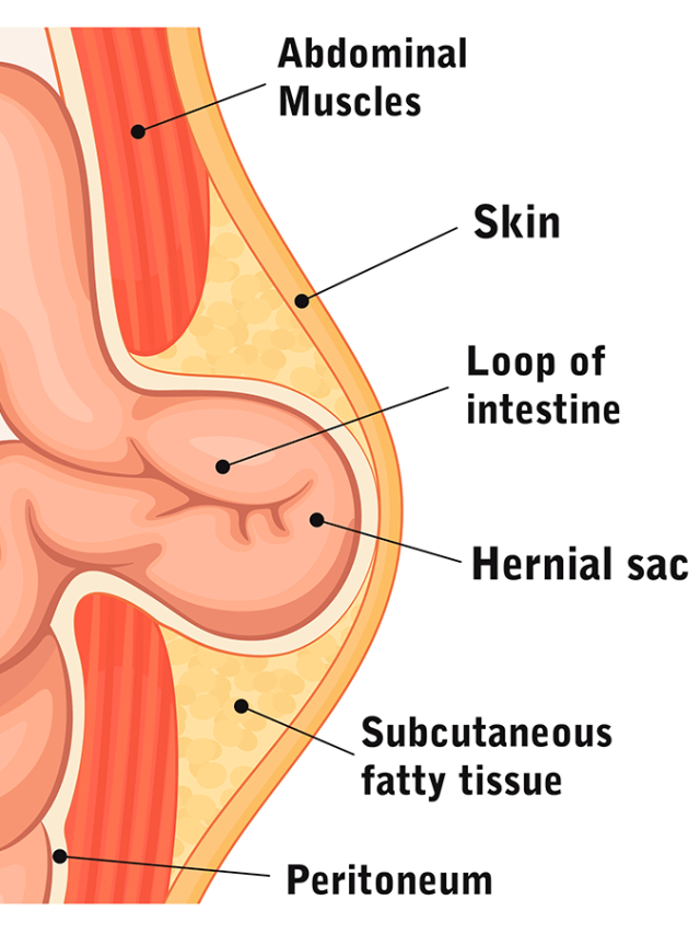 Can umbilical hernia cause weight loss